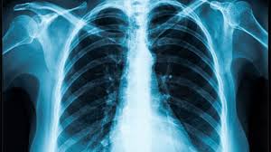 Comparative Evaluation of Pretrained Models for Lung Disease Classification